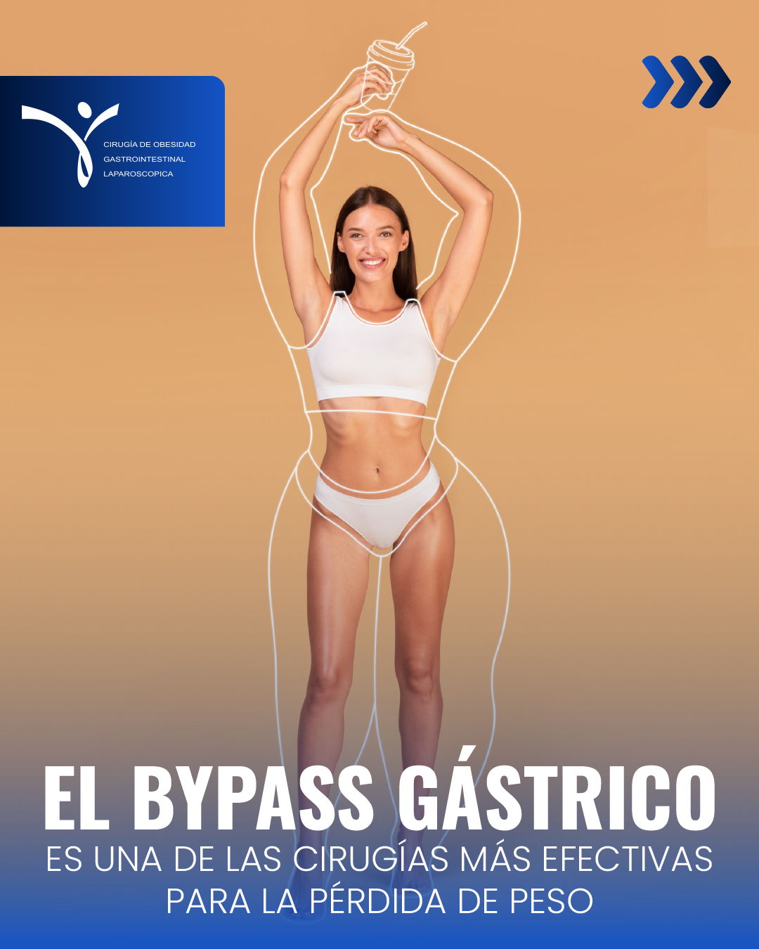 El bypass gástrico, una de las cirugías más efectivas para la pérdida de peso