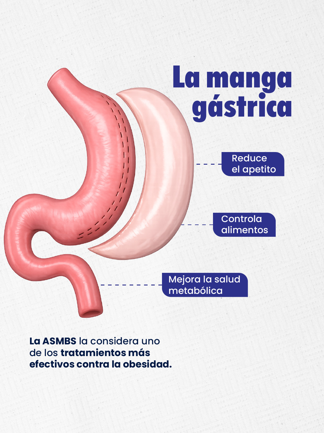 Infografía de la manga gástrica: reduce el apetito, controla alimentos y mejora la salud metabólica