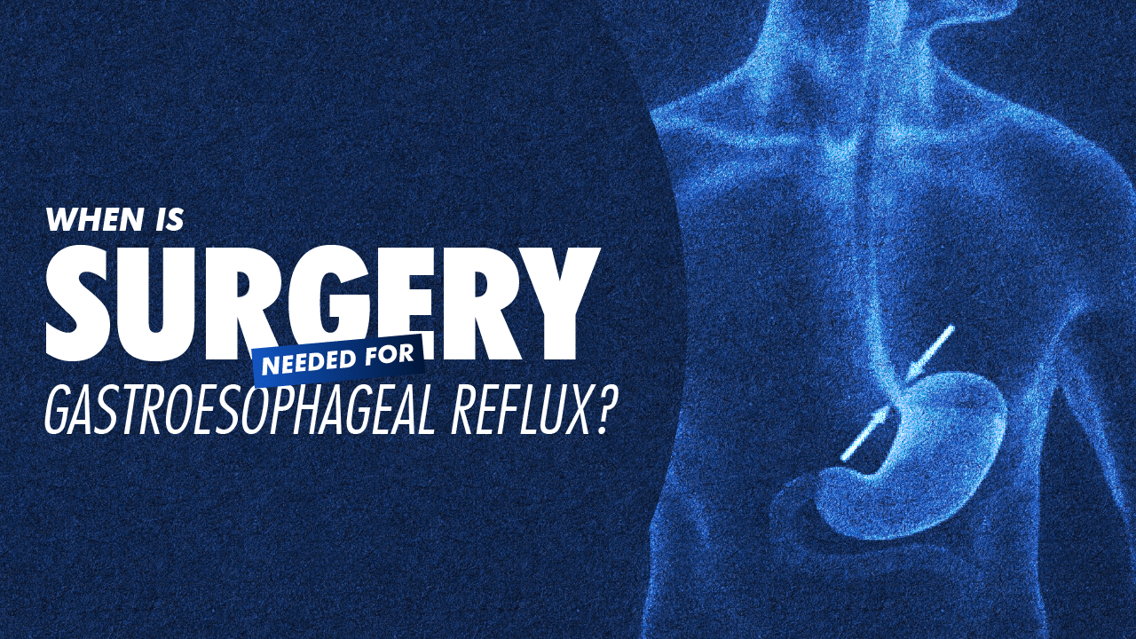Portada · Nissen Fundoplication: The Definitive Guide to Anti-Reflux Surgery