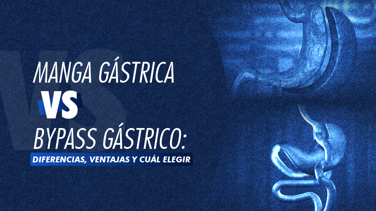 Manga gástrica vs bypass gástrico: diferencias, ventajas y cuál elegir