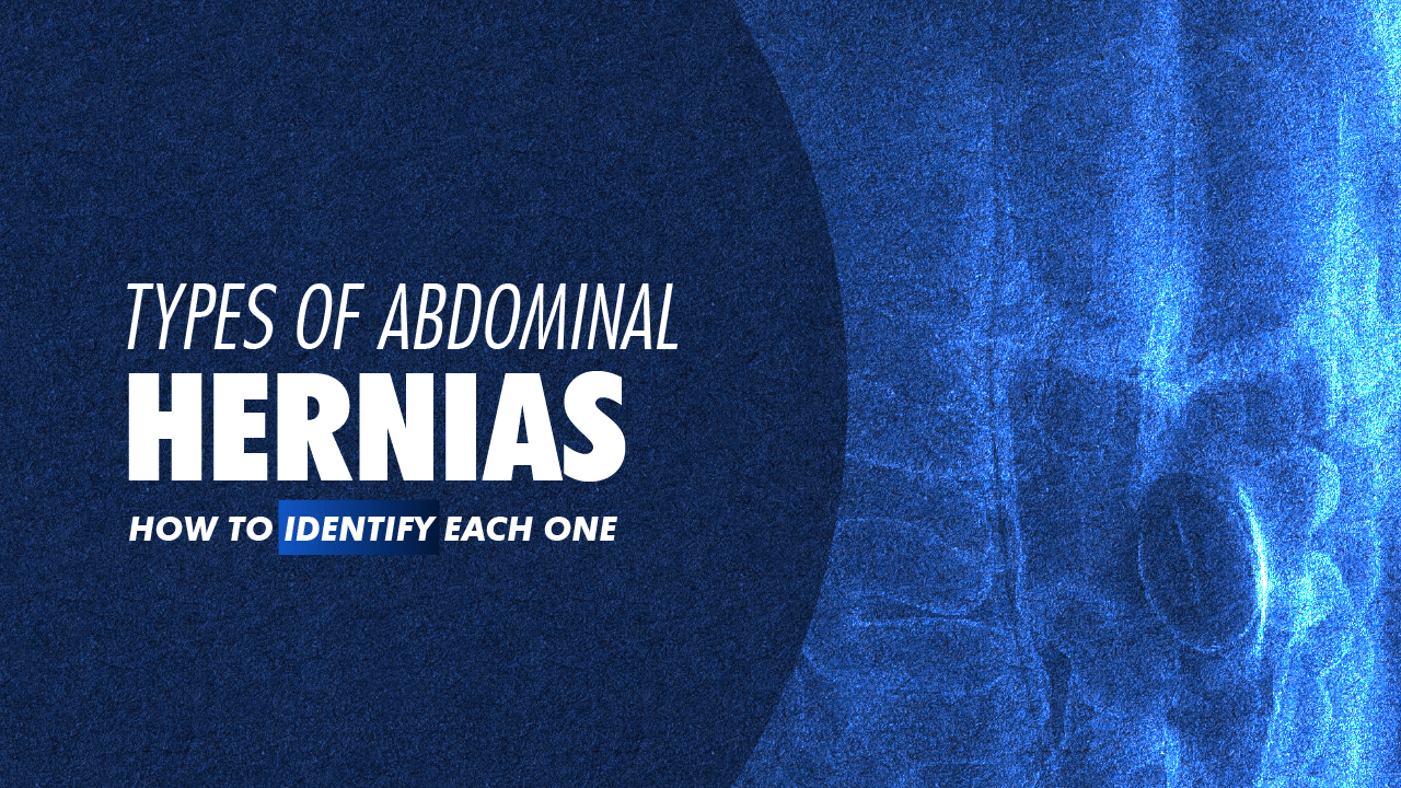 Portada · Types of Abdominal Hernias: A Complete Patient Guide