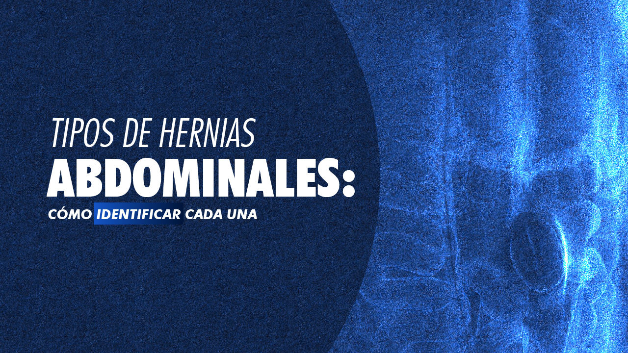Tipos de hernias abdominales: cómo identificar cada una